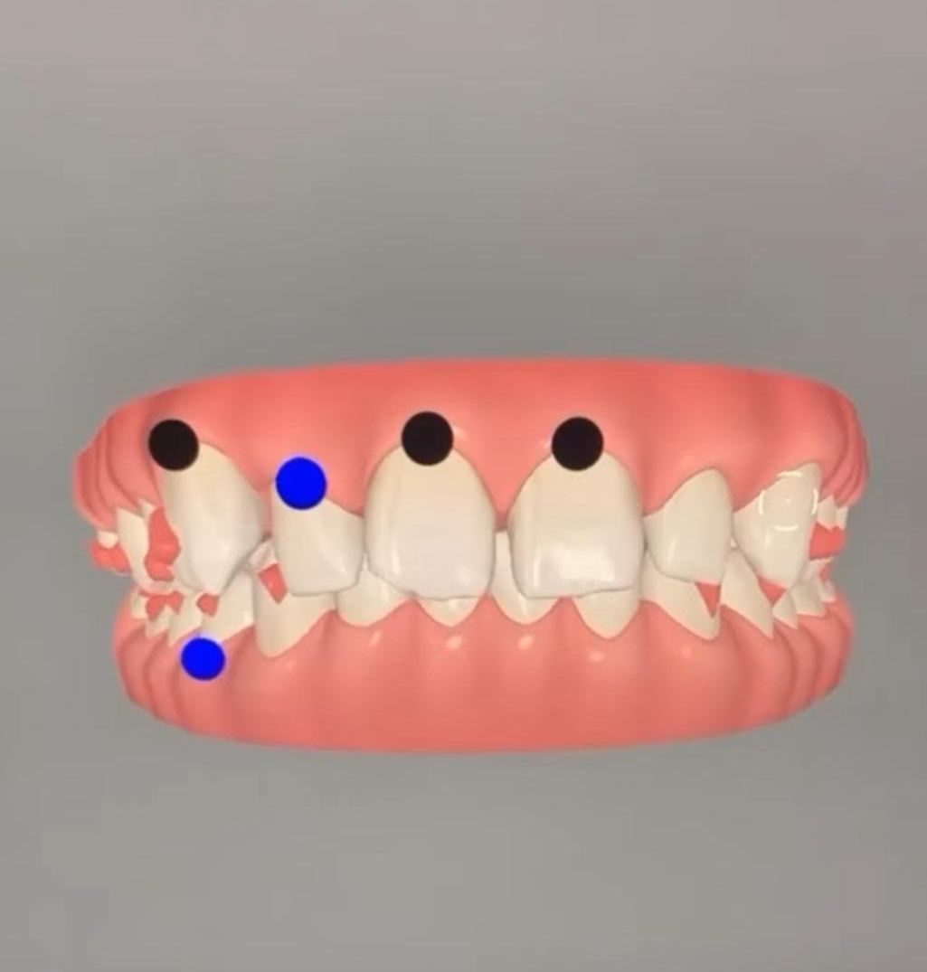Simulation 3D d’un traitement par aligneurs
