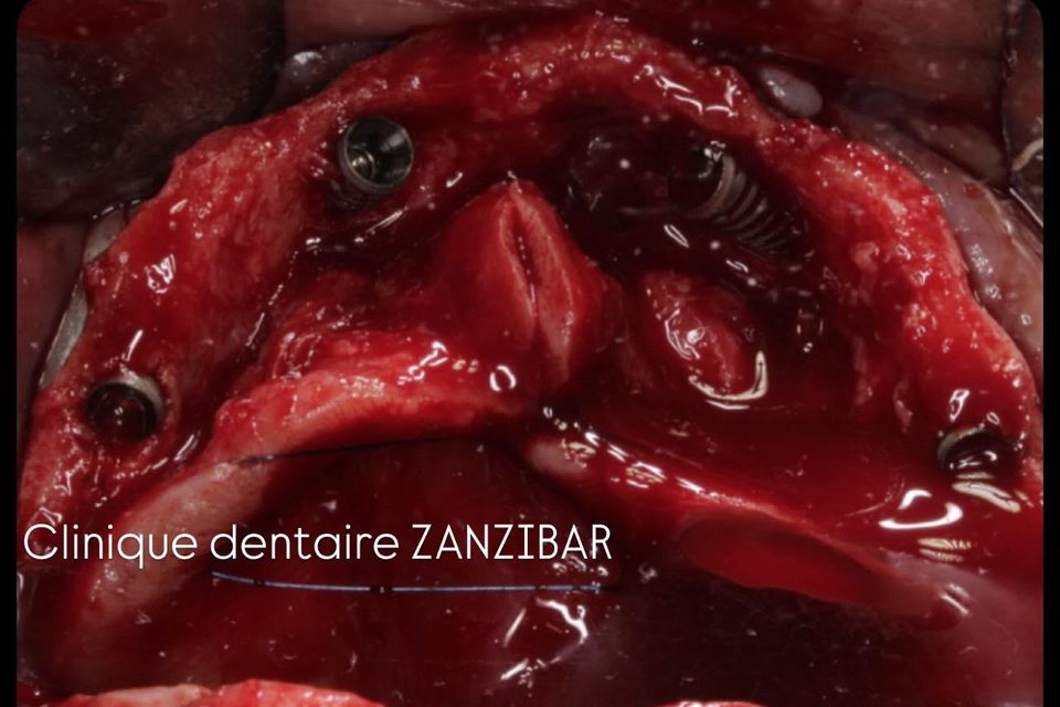 Implants posés dans l’os de la mâchoire supérieure