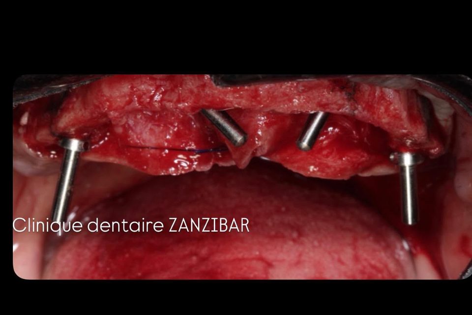 Tiges de contrôle vissées sur les implants pour vérifier leur alignement