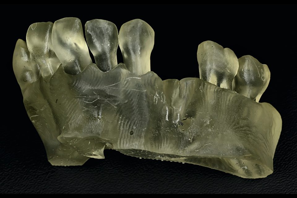 Modèle 3D imprimé de la mâchoire du patient