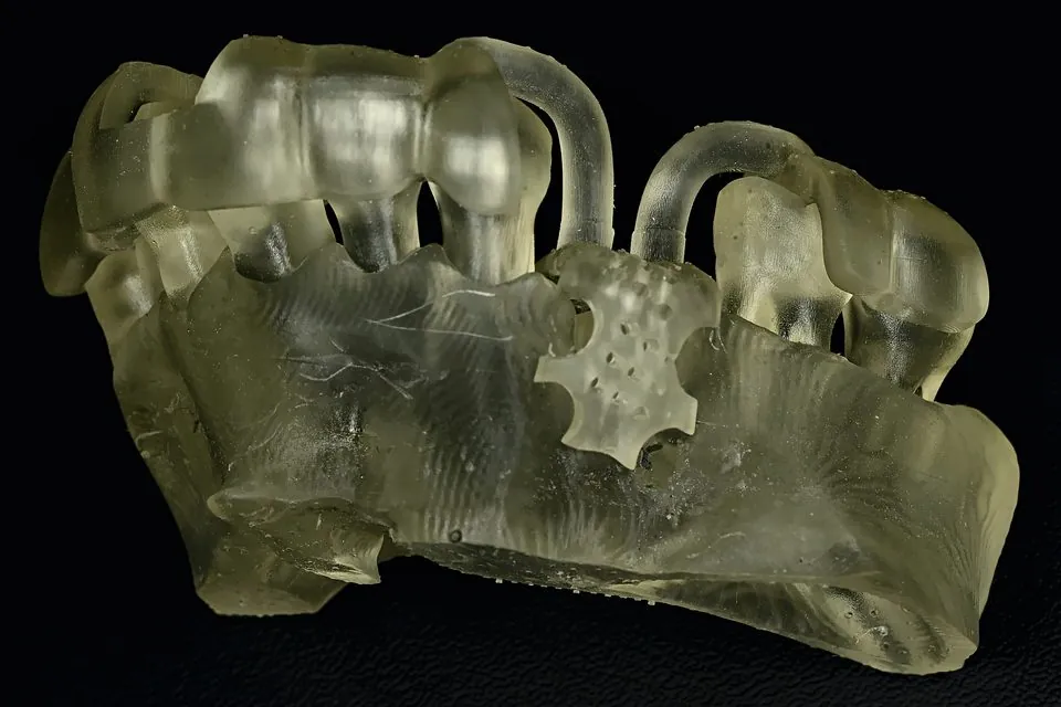 Guide chirurgical imprimé en 3D pour une greffe osseuse, posé sur le modèle de la mâchoire du patient