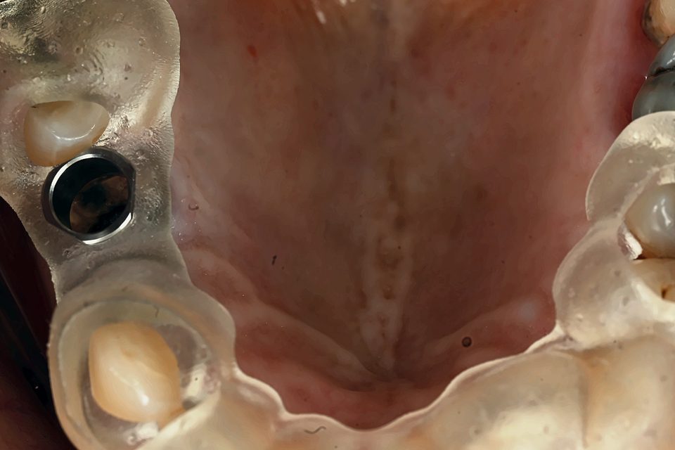 Guide chirurgical essayé en bouche