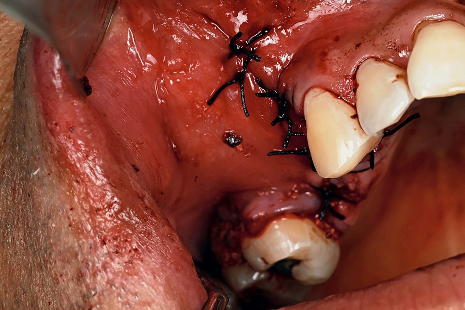 Sutures en fin d’intervention