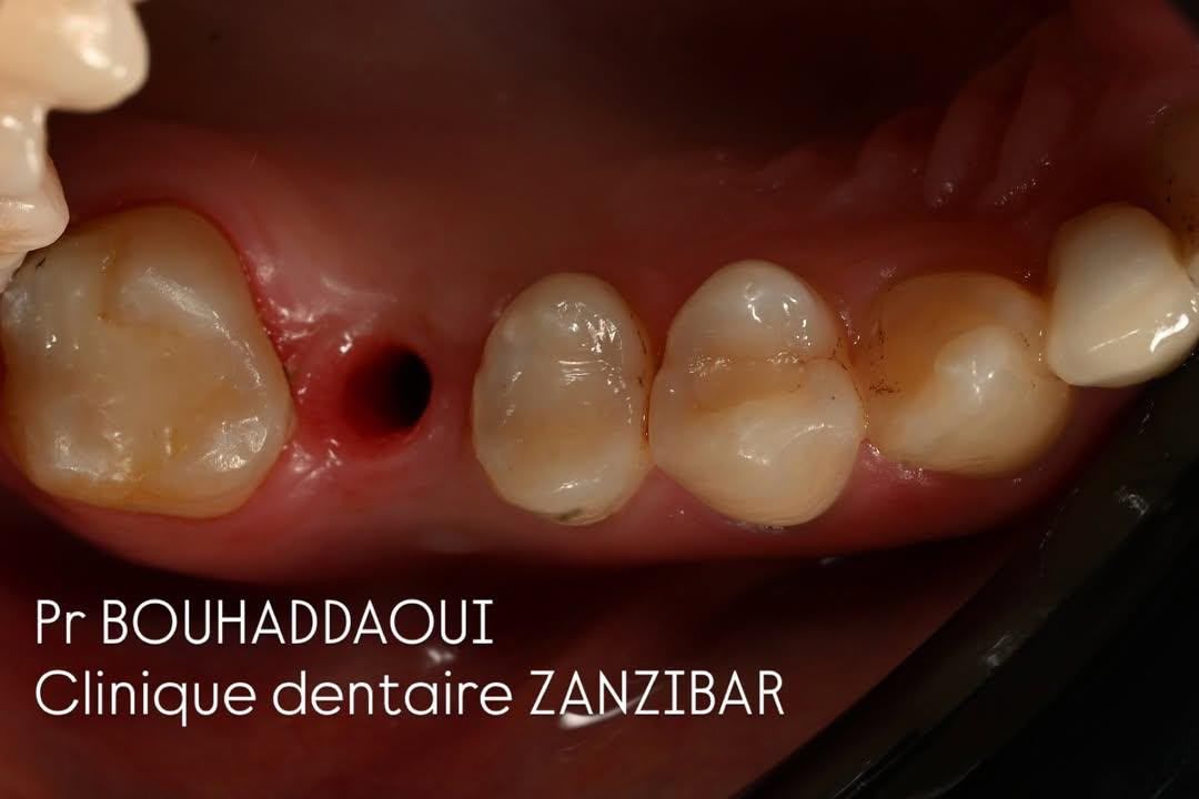 Cas clinique d’implantologie du Pr Bouhaddaoui